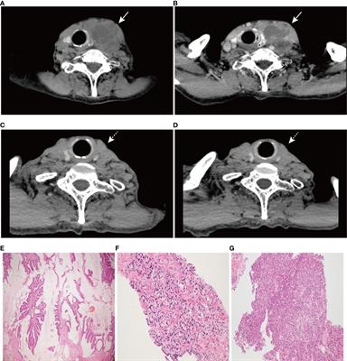 Case report: Undifferentiated sarcoma with multiple tumors involved in Lynch syndrome: Unexpected favorable outcome to sintilimab combined with chemotherapy